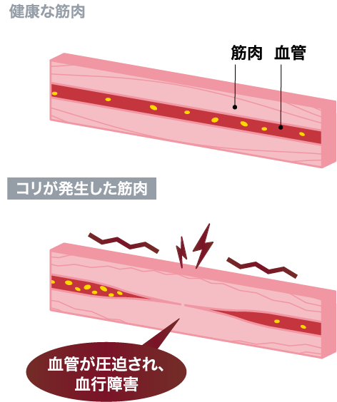 コリが発生した筋肉では血管が圧迫され、血行障害が起こる
