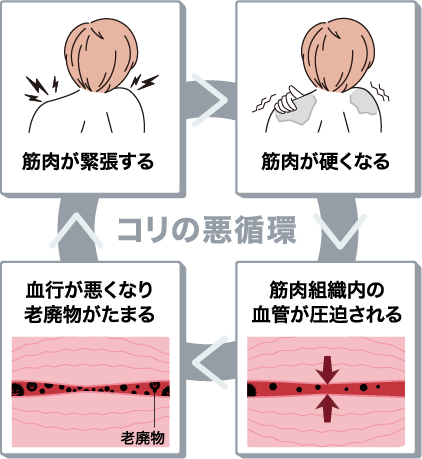 筋肉が緊張し硬くなり、筋肉組織内の血管が圧迫され、血行が悪くなり老廃物がたまる、コリの悪循環